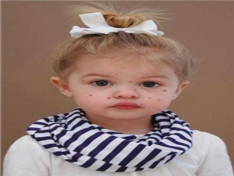 Ανεμοβλογιά: Τι πρέπει να γνωρίζετε γι’ αυτή την συνηθισμένη παιδική ασθένεια