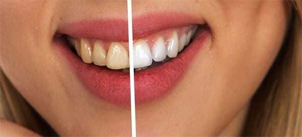 Αμερικάνικη μέλετη δείχνει ότι το ηλεκτρονικό τσιγάρο δεν προκαλεί κηλίδες στα δόντια όπως το κάπνισμα¨
